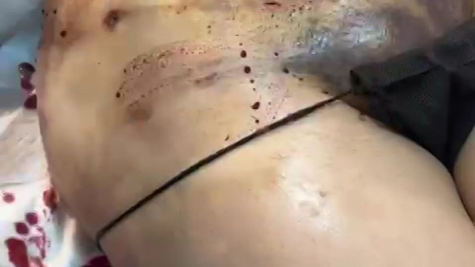 Video Drenaje Abdomen